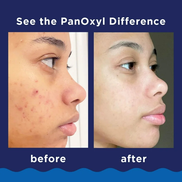 PanOxyl, Foaming Acne Wash Benzoyl Peroxide 10%, Maximum Strength, 156g